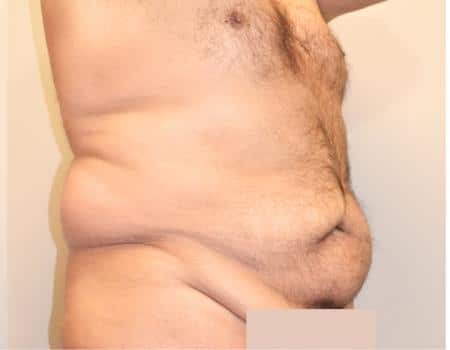 Tummy Tuck Before & After Case 3751
