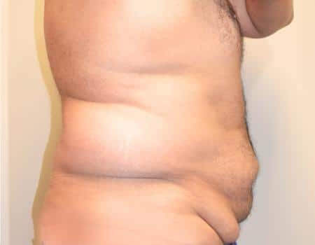Tummy Tuck Before & After Case 3751