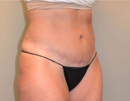 Tummy Tuck Before & After Case 3744