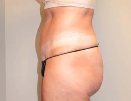 Tummy Tuck Before & After Case 3744