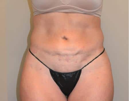 TUMMY-TUCK-C19-B1