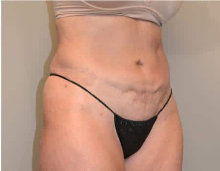 Tummy Tuck Before & After Case 3744