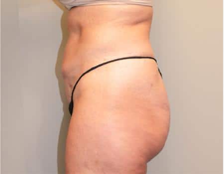 Tummy Tuck Before & After Case 3744