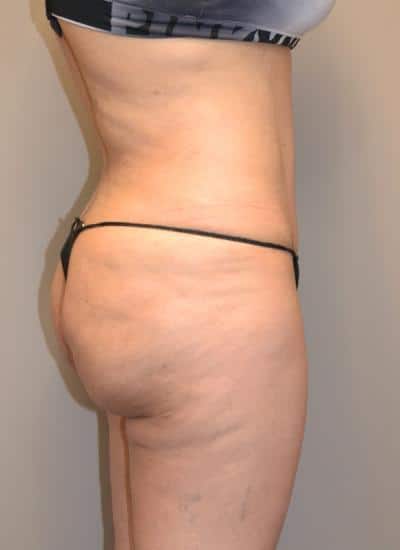 Tummy Tuck Before & After Case 3737