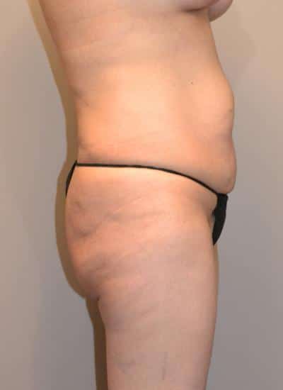 Tummy Tuck Before & After Case 3737