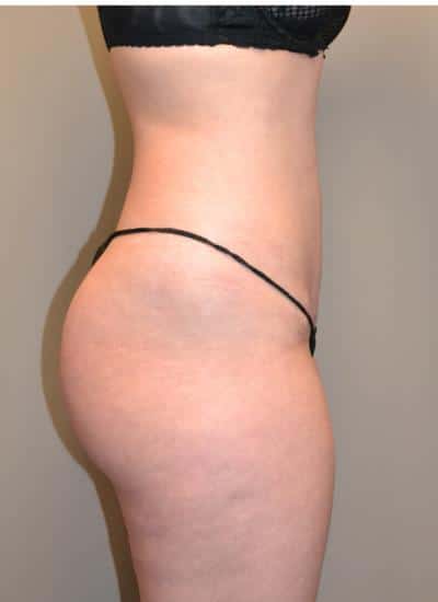 Tummy Tuck Before & After Case 3730