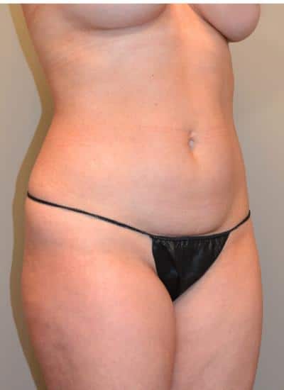 Tummy Tuck Before & After Case 3730