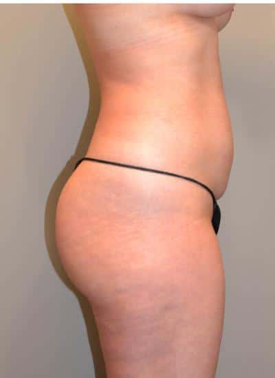 Tummy Tuck Before & After Case 3730