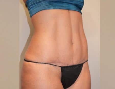 Tummy Tuck Before & After Case 3723