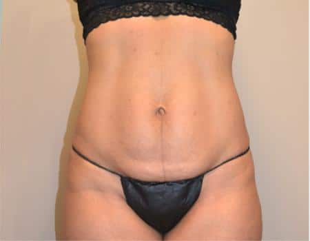 TUMMY-TUCK-C22-B1