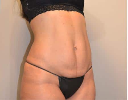 Tummy Tuck Before & After Case 3723