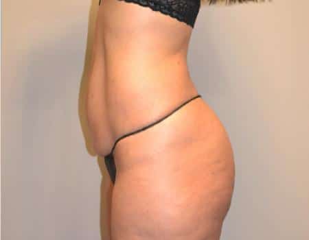 Tummy Tuck Before & After Case 3723