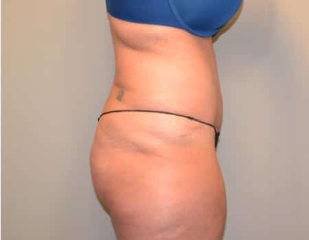 Tummy Tuck Before & After Case 3716