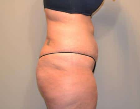 Tummy Tuck Before & After Case 3716