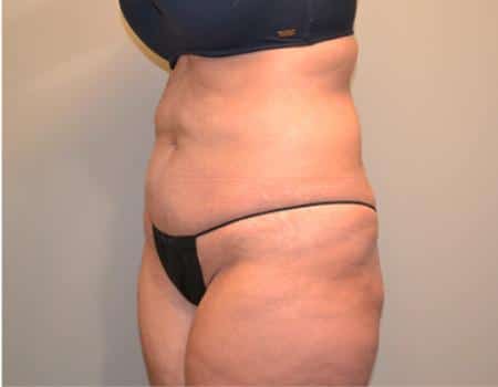 Tummy Tuck Before & After Case 3716