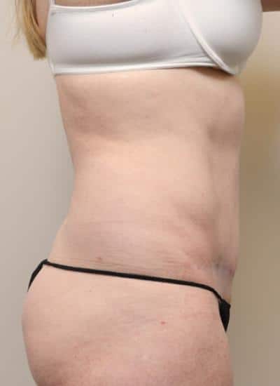 Tummy Tuck Before & After Case 3709