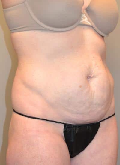 Tummy Tuck Before & After Case 3709