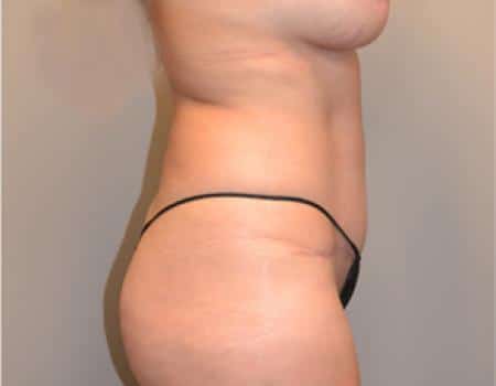 Tummy Tuck Before & After Case 3702