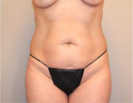 TUMMY-TUCK-C25-B1