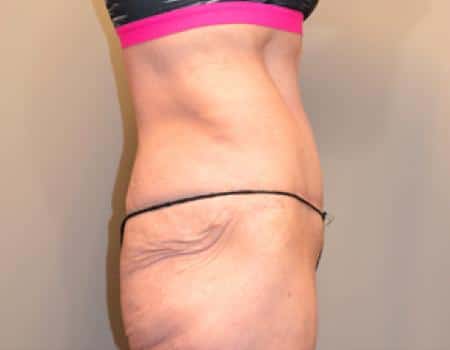 Tummy Tuck Before & After Case 3697