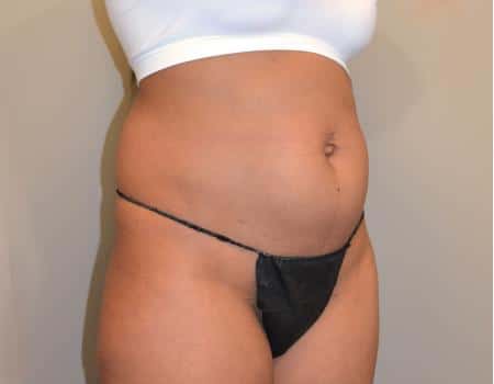 Tummy Tuck Before & After Case 3669