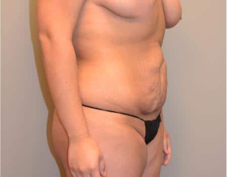 Tummy Tuck Before & After Case 3662