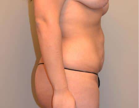 Tummy Tuck Before & After Case 3662
