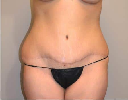 TUMMY-TUCK-C32-A1