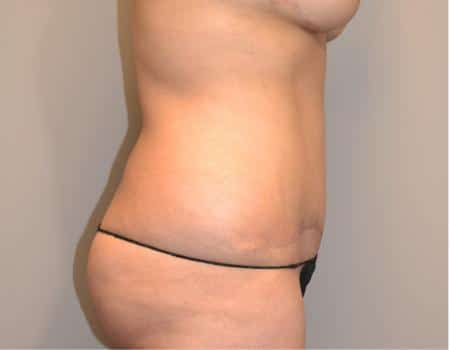 Tummy Tuck Before & After Case 3655