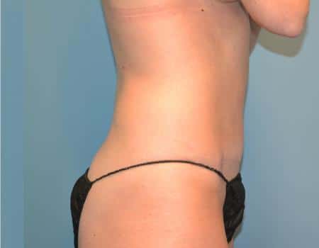 Tummy Tuck Before & After Case 3648