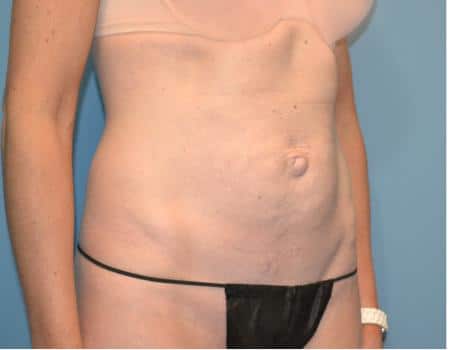 Tummy Tuck Before & After Case 3648