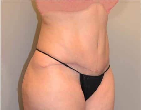 Tummy Tuck Before & After Case 3641