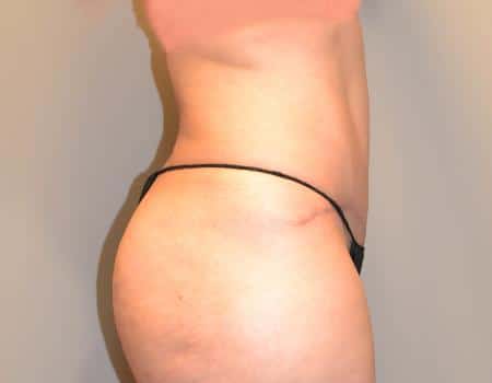 Tummy Tuck Before & After Case 3641