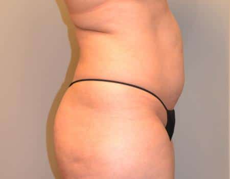 Tummy Tuck Before & After Case 3641