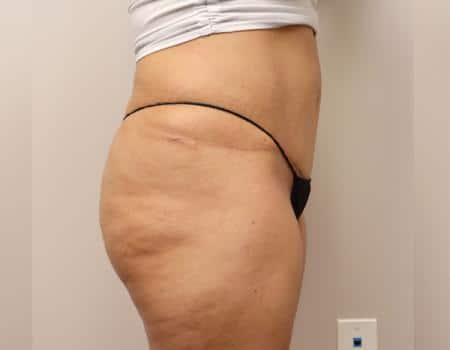 Tummy Tuck Before & After Case 3829