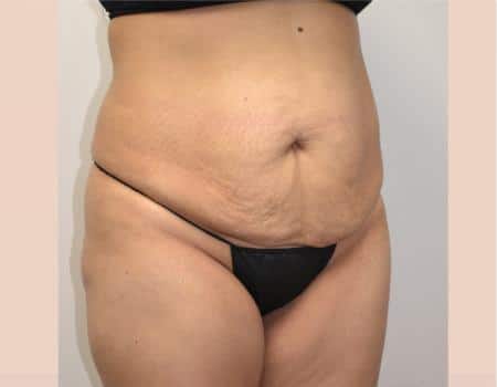 Tummy Tuck Before & After Case 3829