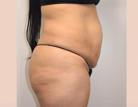 Tummy Tuck Before & After Case 3829