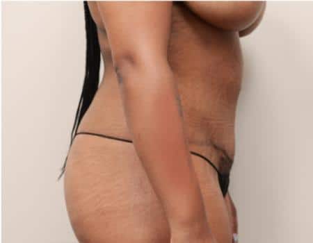 Tummy Tuck Before & After Case 3822