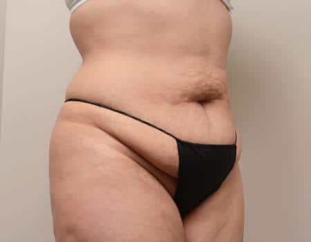 Tummy Tuck Before & After Case 3815