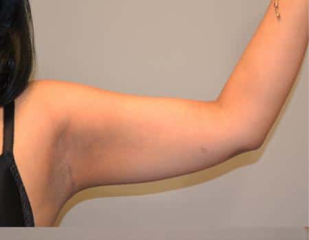 Arm Lift Before & After Case 4059