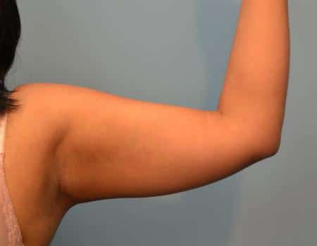 Arm Lift Before & After Case 4059