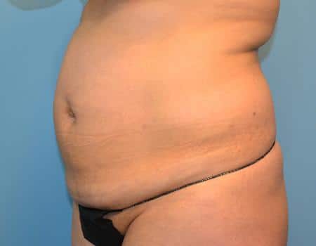 Tummy Tuck Before & After Case 3867