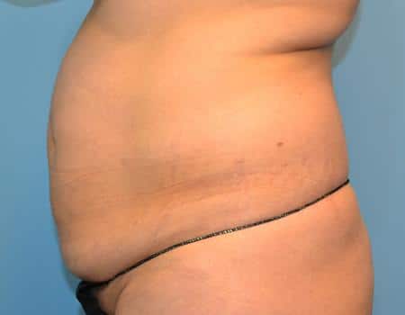 Tummy Tuck Before & After Case 3867
