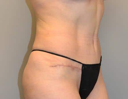 Tummy Tuck Before & After Case 3860