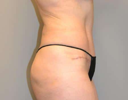 Tummy Tuck Before & After Case 3860