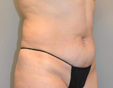 Tummy Tuck Before & After Case 3860