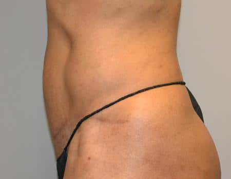 Tummy Tuck Before & After Case 3846