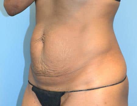 Tummy Tuck Before & After Case 3846