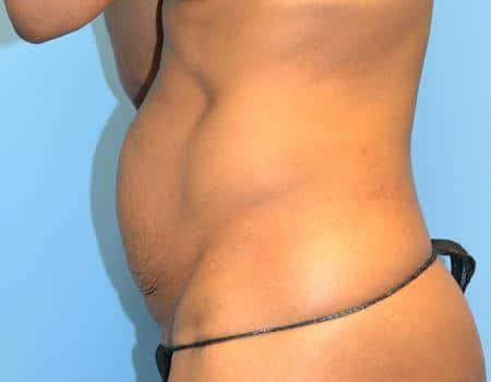 Tummy Tuck Before & After Case 3846