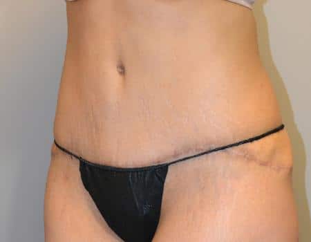 Tummy Tuck Before & After Case 3836